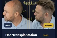 Haartransplantation Mannheim