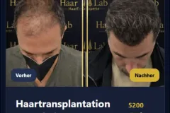 Haartransplantation Mannheim Kosten