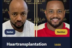 Haartransplantation Mannheim