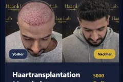 Haartransplantation Mannheim