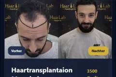 Haartransplantation Mannheim