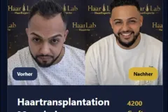Haartransplantation Mannheim