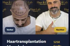 Haartransplantation Mannheim