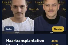 Haartransplantation Mannheim