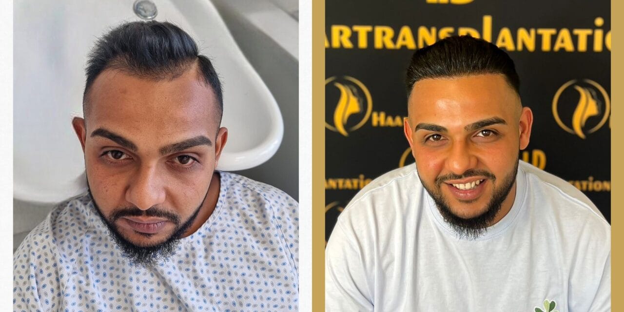 Haartransplantation Mannheim – Das sollten Sie wissen!