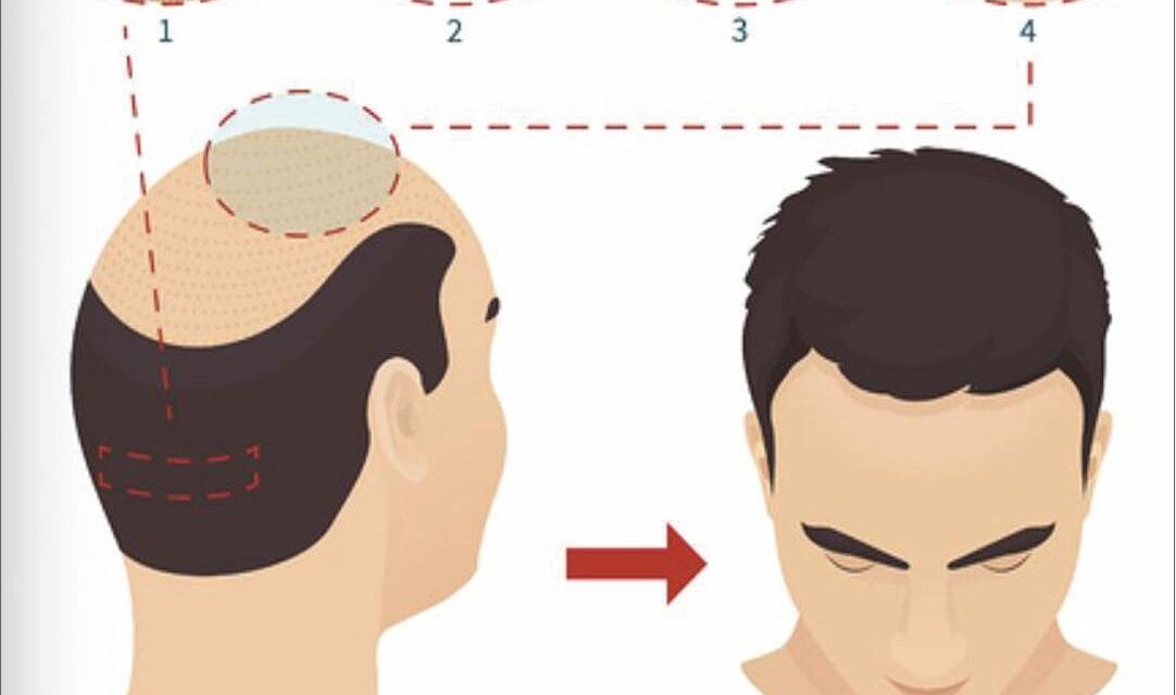Haartransplantation Mannheim Preise – Was kostet eine Haartransplantation in Mannheim 2025?