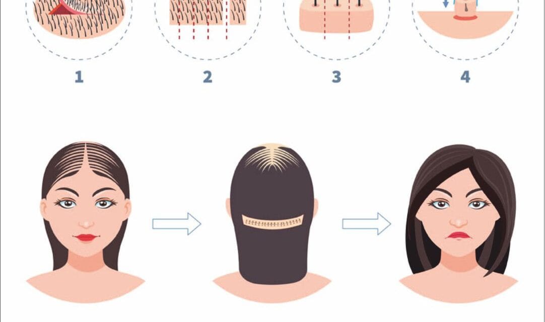 Haarverpflanzung bei Frauen – Ursachen, Methoden und natürliche Ergebnisse