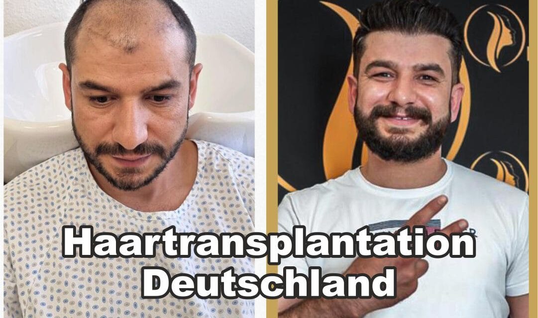Hair Transplant Mannheim – Costs, Methods & Expert Clinics 2025