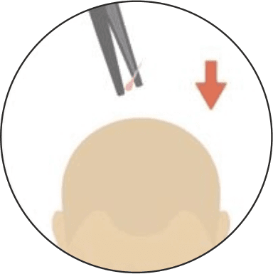 https://www.haartransplantationmannheim.com/wp-content/uploads/2025/06/haartransplantation-mannheim-4.png