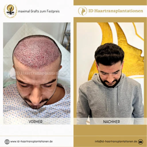 Nach der Haartransplantation – Was beachten für ein optimales Ergebnis?