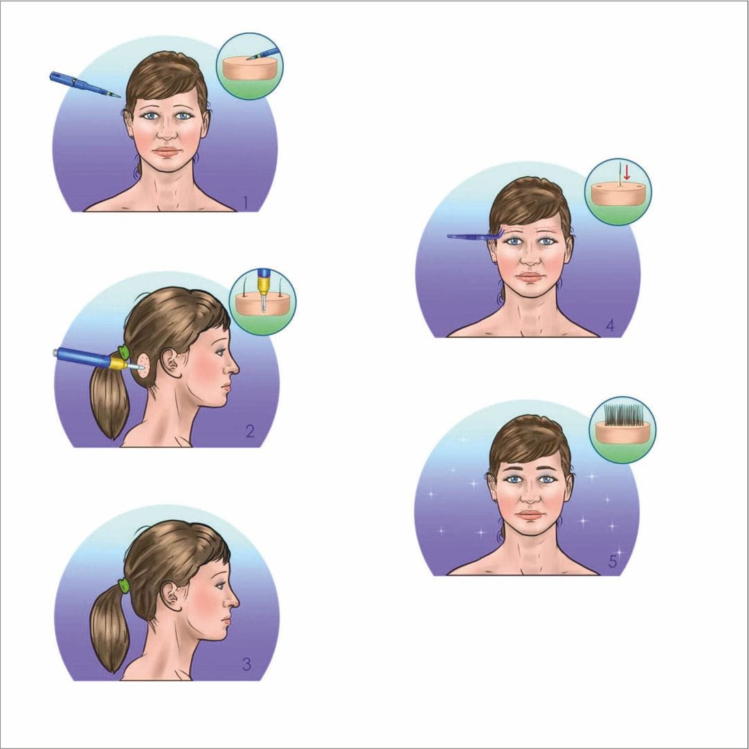 https://www.haartransplantationmannheim.com/wp-content/uploads/2025/06/mannheimhaartransplantation-fue-augenbrauentransplantation.jpg