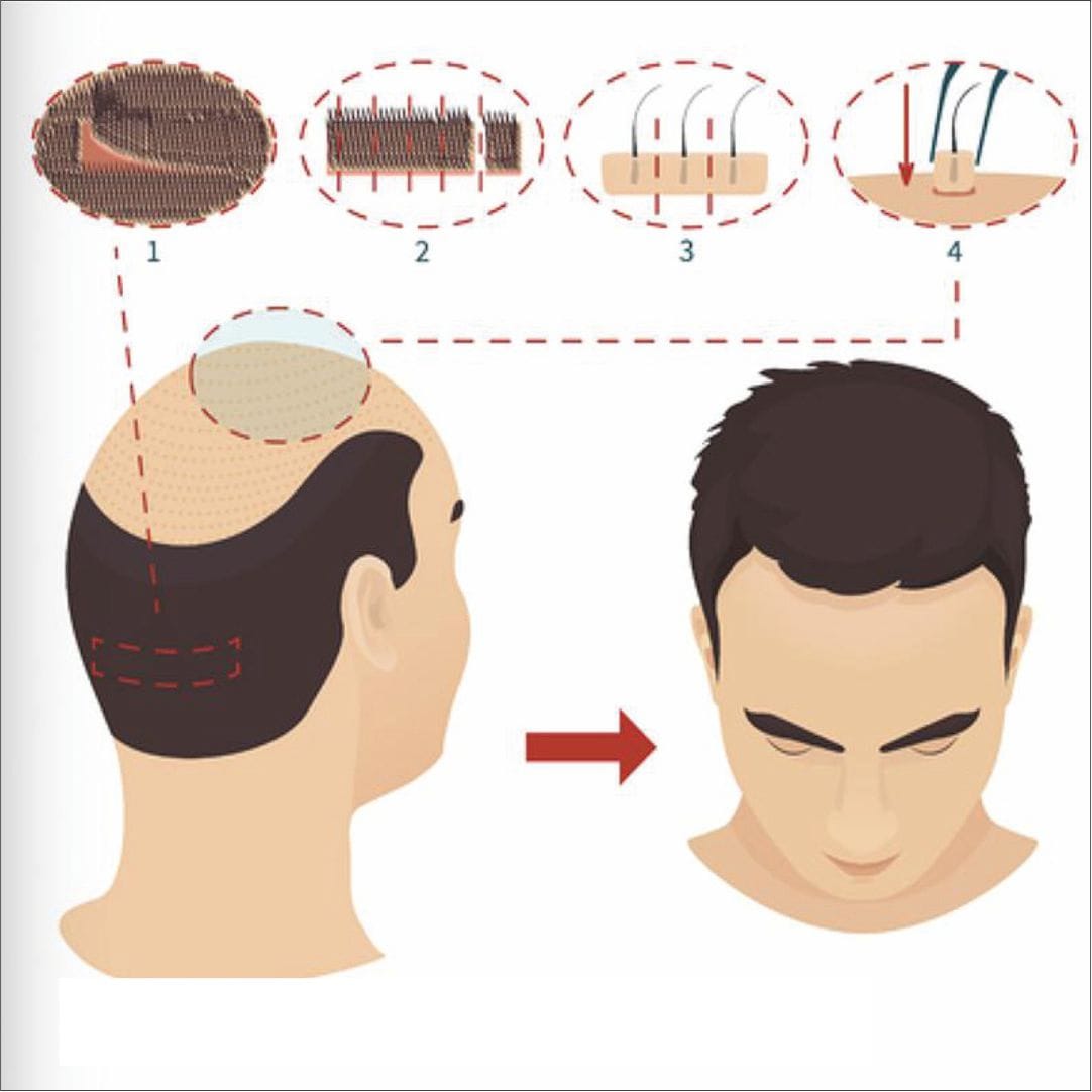 https://www.haartransplantationmannheim.com/wp-content/uploads/2025/06/mannheimhaartransplantation-fue-haartransplantation-1.jpg