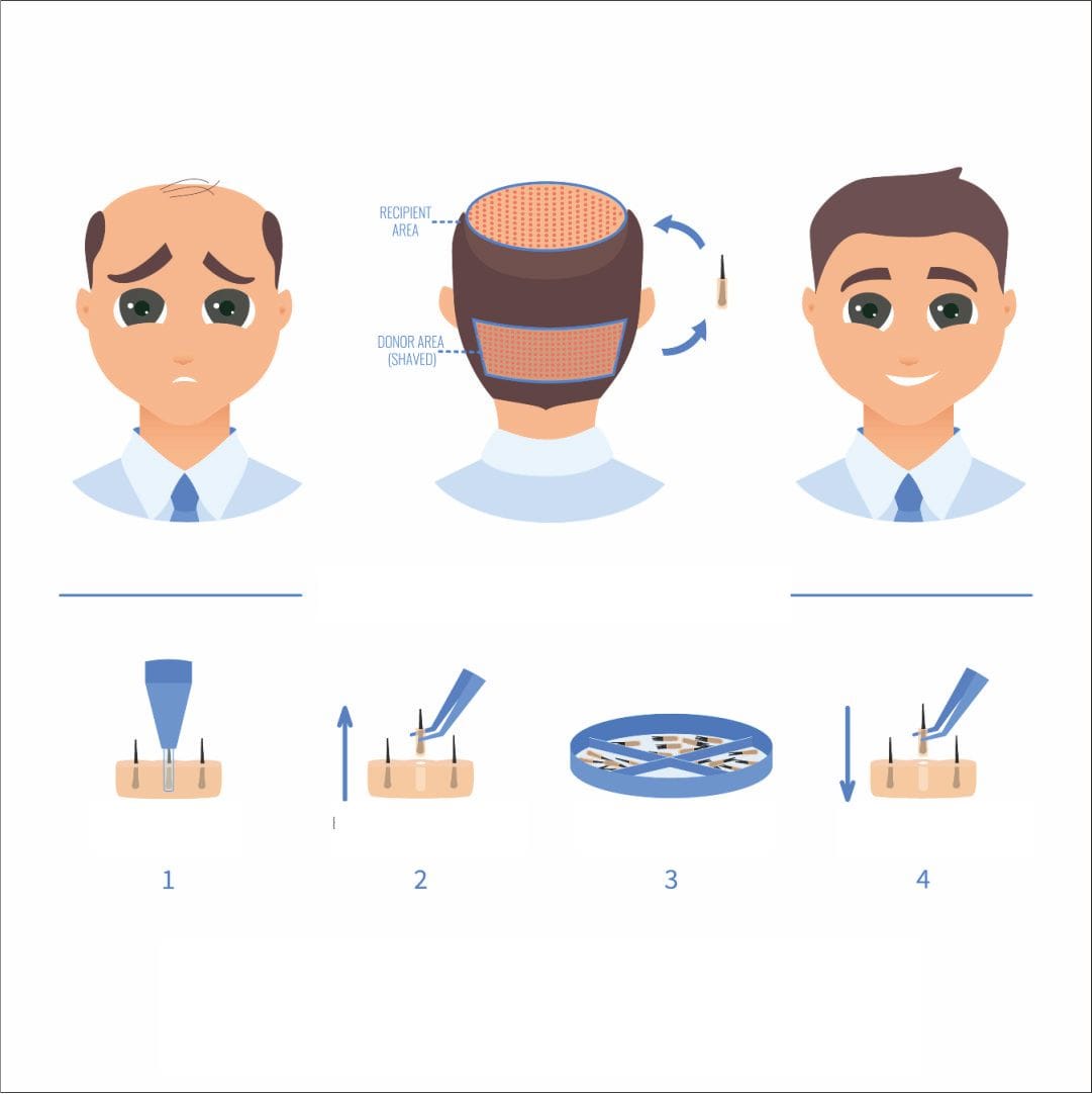 https://www.haartransplantationmannheim.com/wp-content/uploads/2025/06/mannheimhaartransplantation-saphir-haartransplantation.jpg