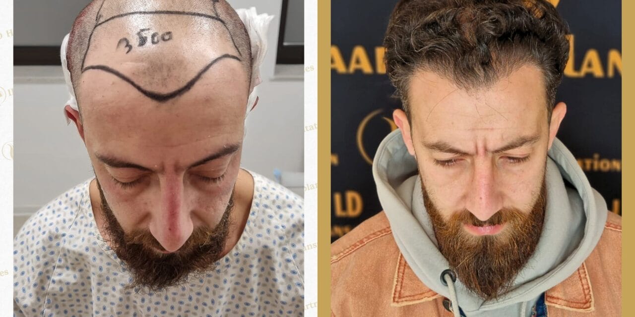 Haartransplantation Mannheim Sandhofen: Alles, was Sie wissen müssen