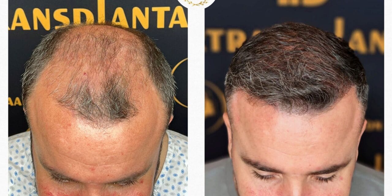 Wie viel kostet eine Haartransplantation in Mannheim?