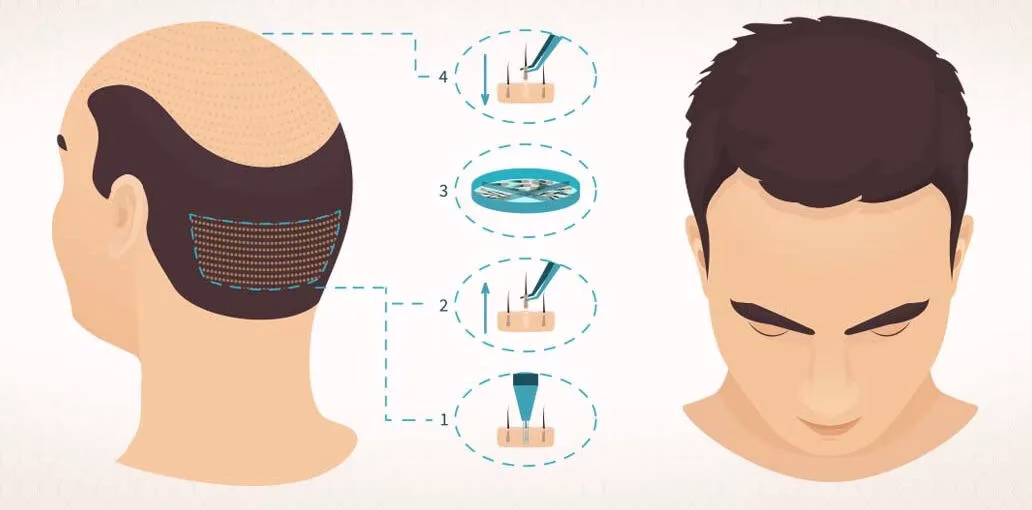 https://www.haartransplantationmannheim.com/wp-content/uploads/2025/09/fue-sac-ekimi-nedir.avif