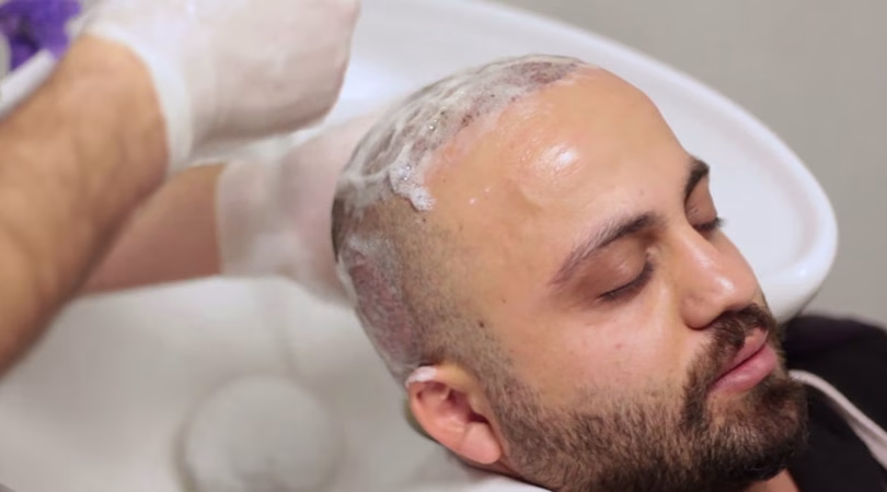 Haartransplantation 1 Monat: Schockverlust, Pflege & Sport