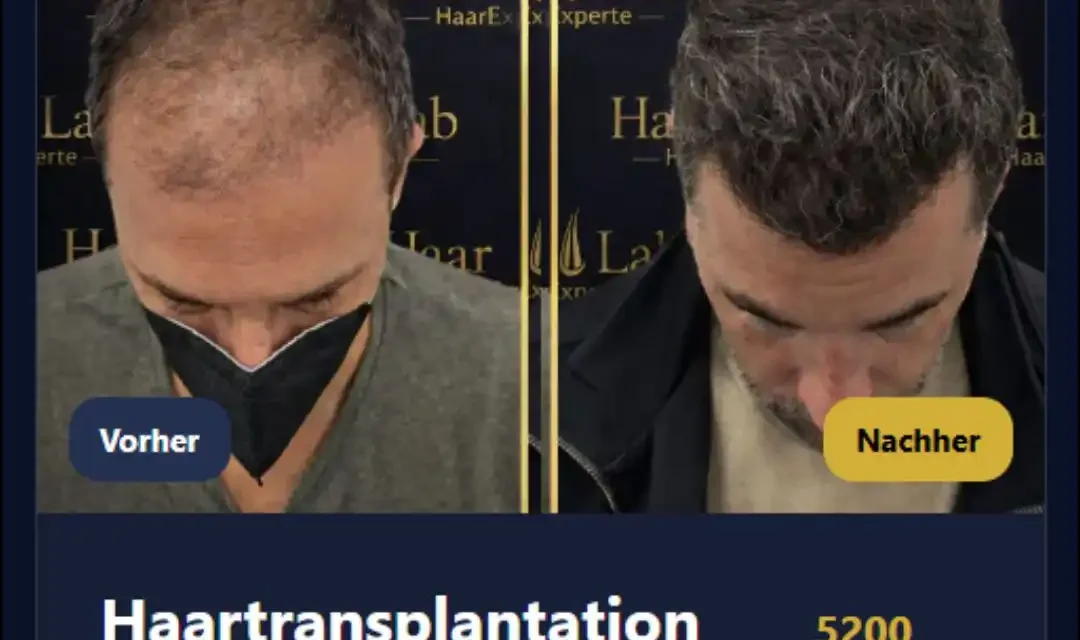 Haarausfall Mannheim – Ursachen, Behandlungen und Lösungen bei ID Haartransplantationen