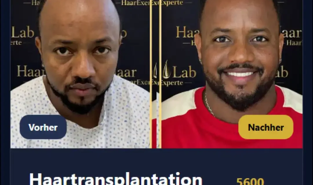 Barthaartransplantation Mannheim – Dichter Bart, neues Selbstbewusstsein