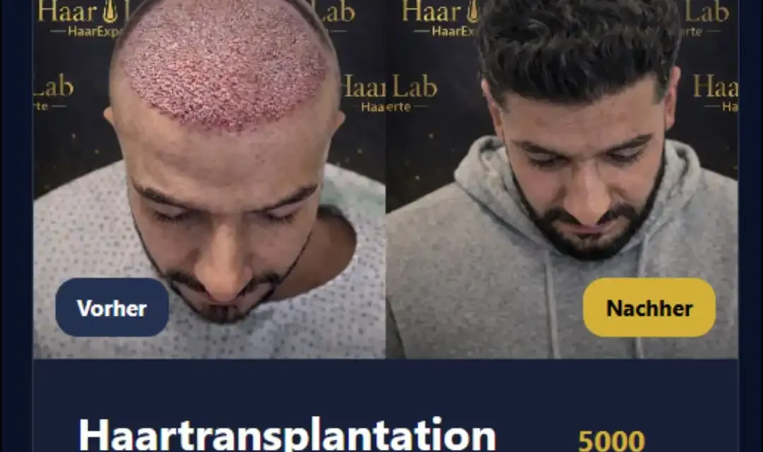 Haartransplantation Heidelberg