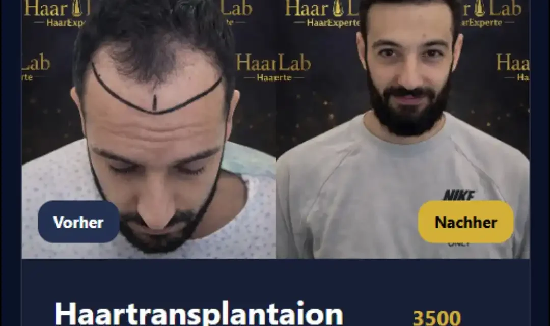 Haartransplantation Hessen | Natürliches Ergebnis bei ID Haartransplantationen