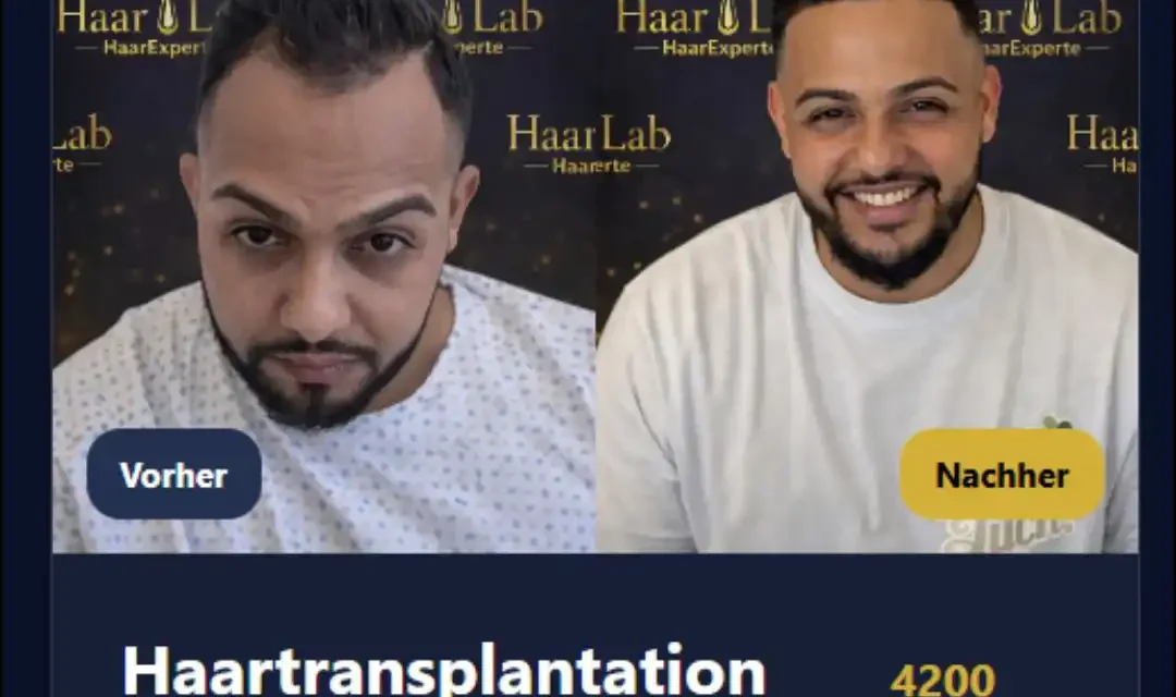 Haartransplantation Risiken & Nebenwirkungen 2025 | ID Haartransplantationen Mannheim