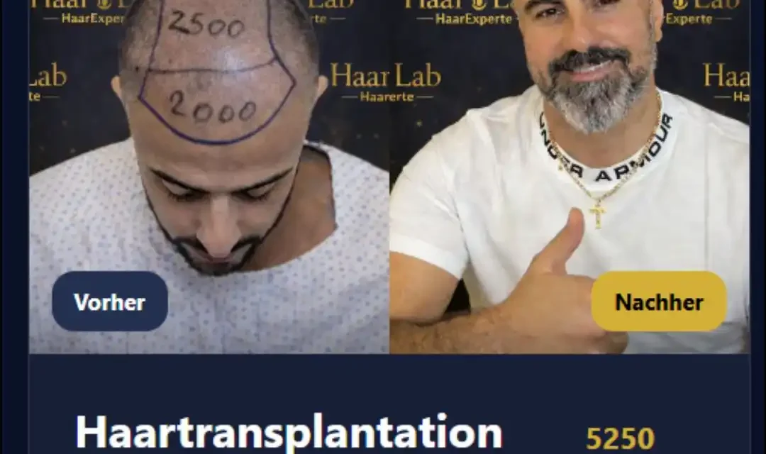 Haarverpflanzung Heidelberg – Natürliches Haarwachstum mit ID Haartransplantationen