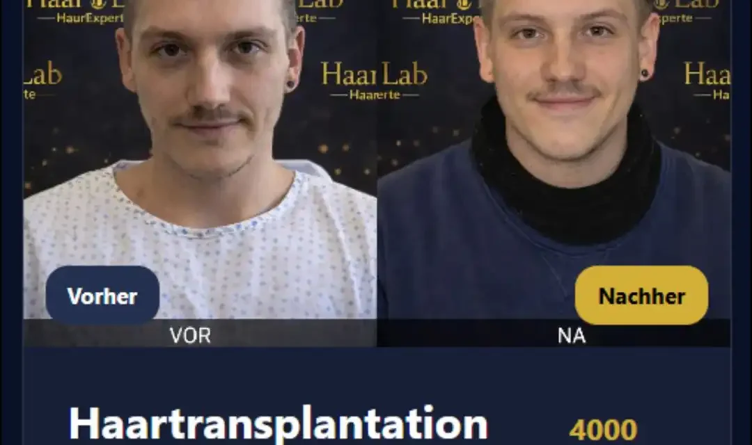 Haartransplantation Deutschland Kosten 2025 – Preise & Möglichkeiten